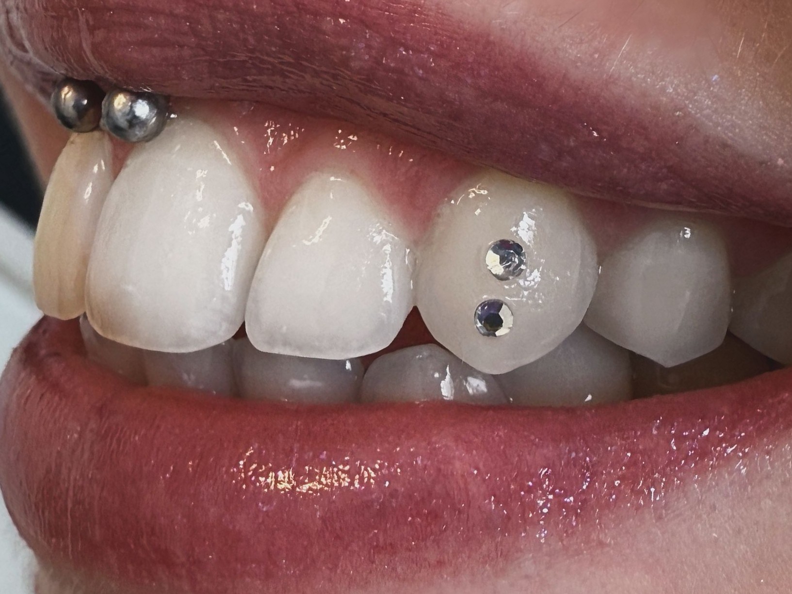 Twee toothgems op een tand, van opzij