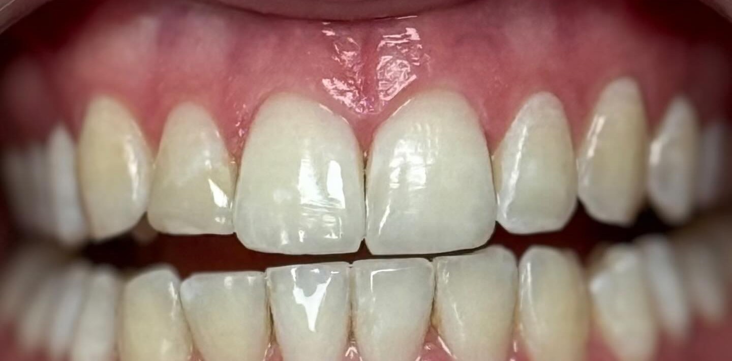 Glow White, na de behandeling