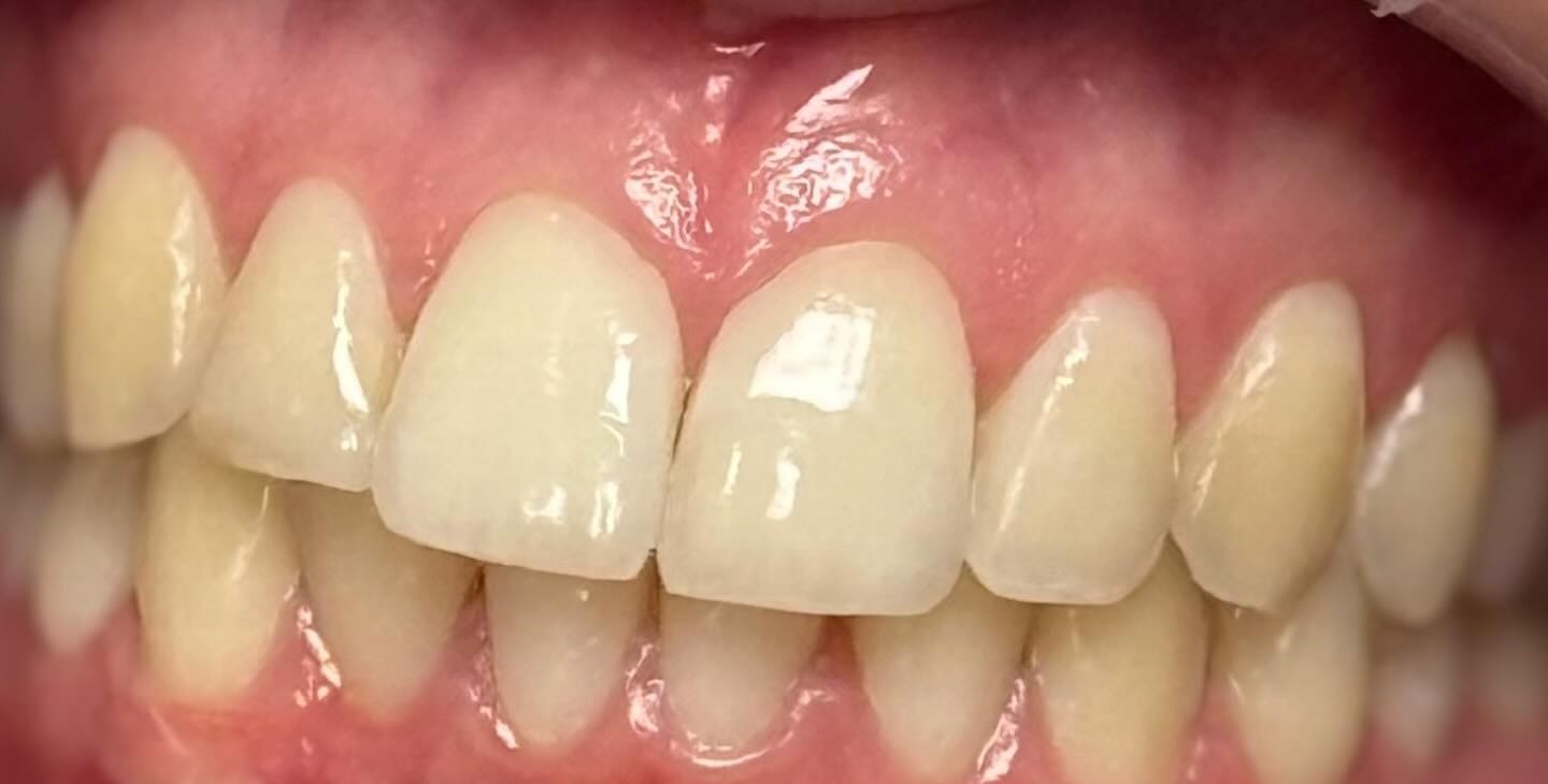 Glow White, voor de behandeling