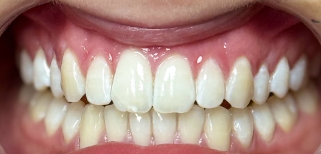 Deluxe White, na de behandeling