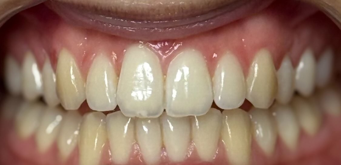 Deluxe White, voor de behandeling