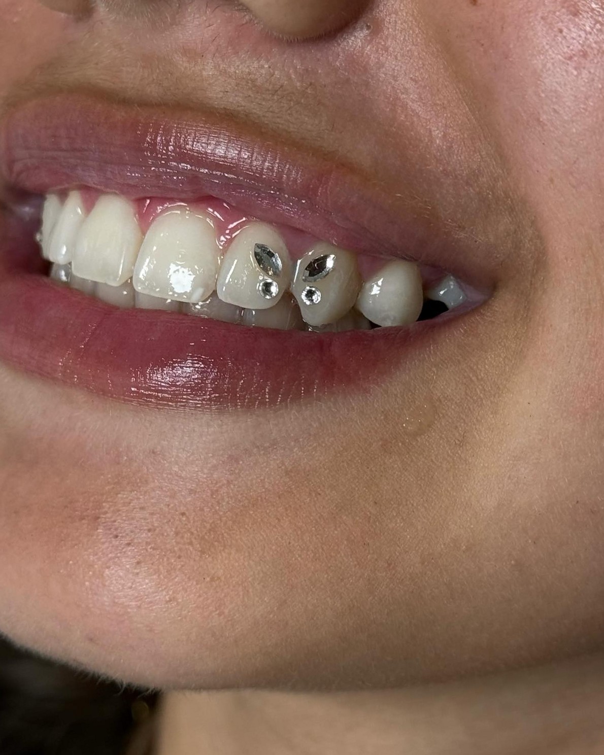 Butterfly toothgem design: kristallen in de vorm van een vlinder op de tanden